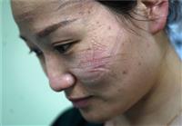 Bác sĩ Vũ Hán mặt hằn vết khẩu trang, đóng tã khi làm việc